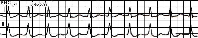 Рис.15 – Суправентрикулярная тахикардия с узким QRS