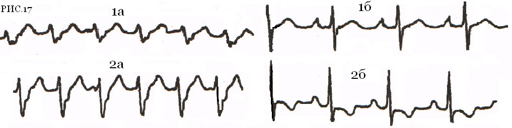 Рис.17 – Тахикардия неясного генеза с широким QRS