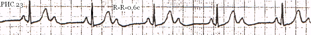 Рис.23 – Атриовентрикулярная блокада II степени типа Мобиц -2