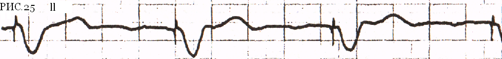 Рис.25 – ЭКГ с кардиостимулятором