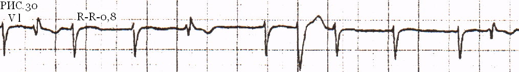 Рис.30 – Мерцательная аритмия с аберрантными комплексами QRS (симулирующая экстрасистолию)