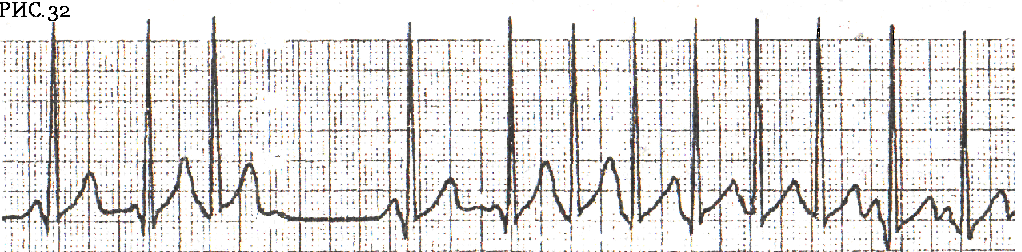 Рис.32 – Короткий пароксизм тахикардии с узким QRS