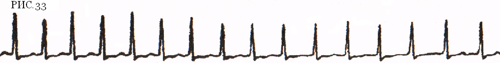 Рис.33 – Пароксизмальная тахикардия с узким QRS