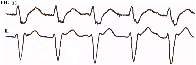 Рис.35 – Пароксизмальная тахикардия с широким QRS