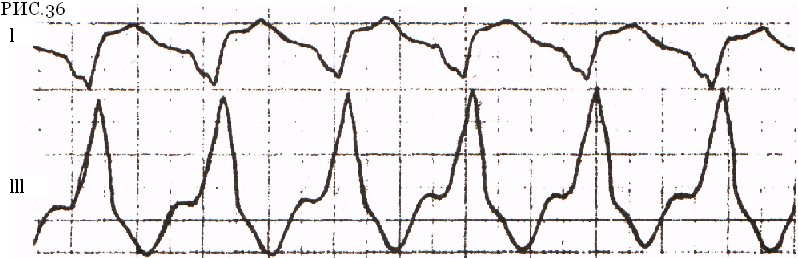 Рис.36 – Пароксизмальная тахикардия с широким QRS