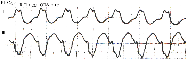 Рис.37 – Пароксизмальная тахикардия с широким QRS