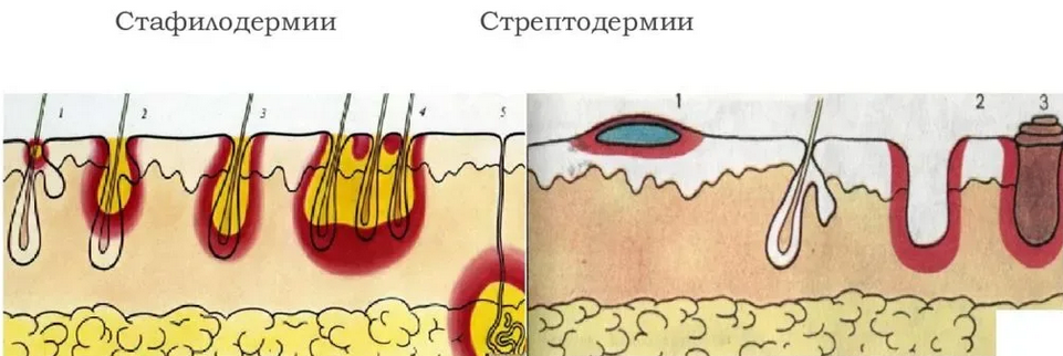 Пиодермии, стафилодермии, стрептодермии