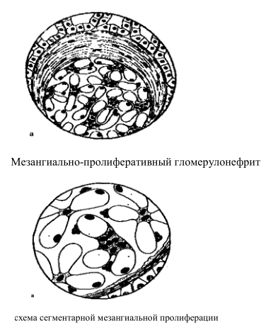 меганзиально-пролиферативный гломерулонерит