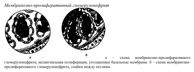 Мембранозно-пролиферативный гломерулонефрит