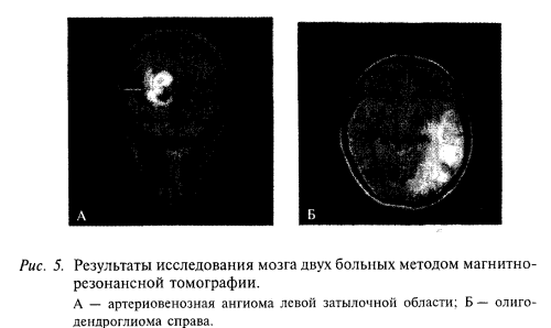 МРТ атриовентрикулярная ангиома, олигодендрома