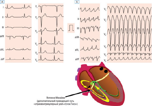 Дополнительный путь. Wpw феномен Махайма. Пучок Махайма на ЭКГ. Тахикардия Махайма. Дополнительные пути проведения на ЭКГ.