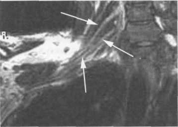 МРТ плечевого сплетения. Корональная плоскость