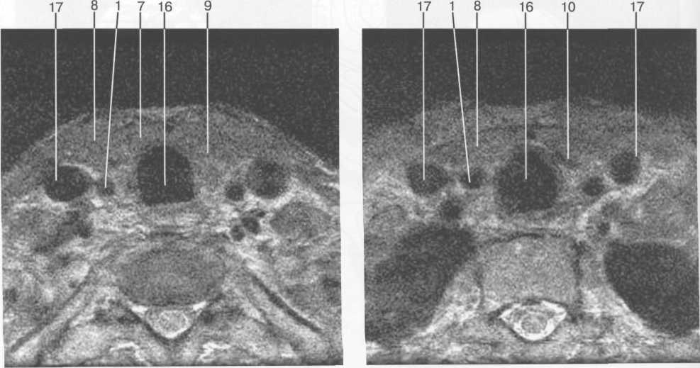 МРТ щитовидной железы на уровне щитовидного хряща