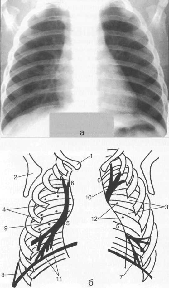 Обзорная рентгенограмма (а) и схема (б) органов грудной клетки ребенка 6 месяцев.