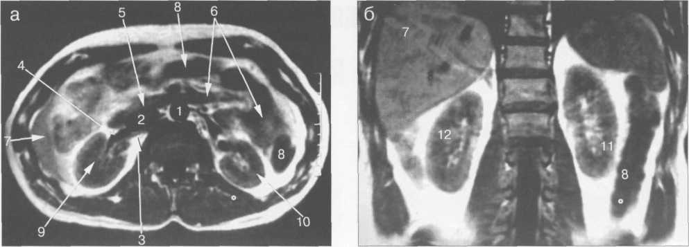 МРТ брюшной полости и забрюшинного пространства. Поперечное (а) и корональное (б) изображение на уровне ворот почек.