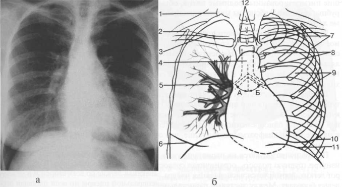 Рентгенограмма грудной клетки в передней проекции (а) и схема (б)