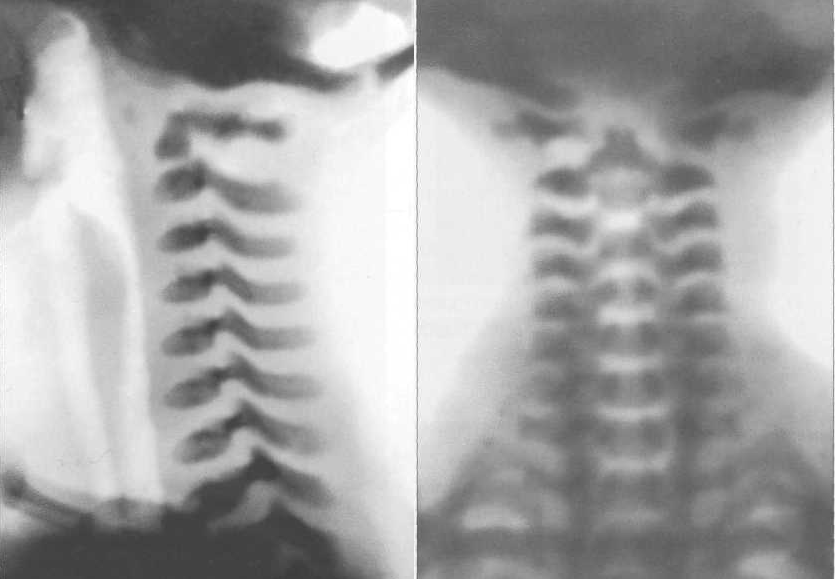 Рентгенограммы шейного отдела позвоночника новорожденного и схемы.