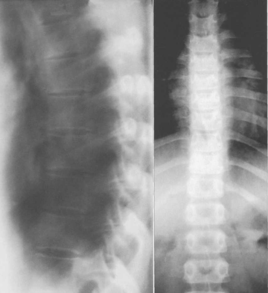 Обзорные грудные спондилограммы взрослого.