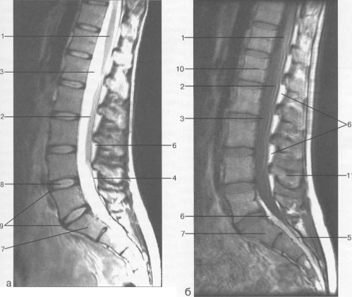 Срединные сагиттальные МРТ пояснично-крестцового отдела позвоночника