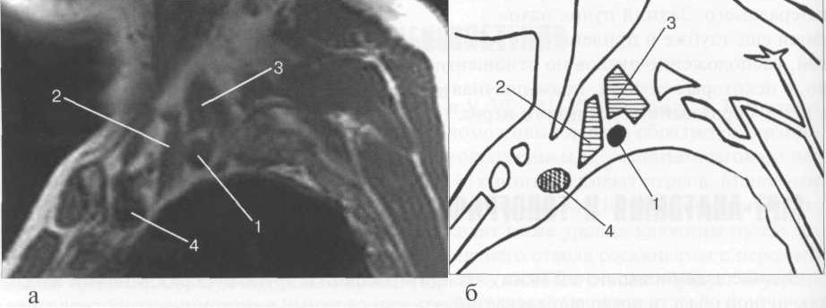 MPT плечевого сплетения. Сагиттальная плоскость. Т1-ВИ