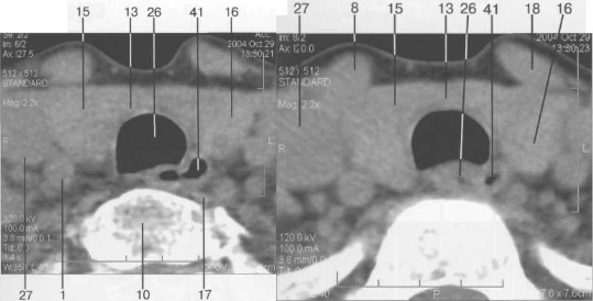 Серия КТ щитовидной железы в аксиальной проекции на уровне щитовидного хряща.