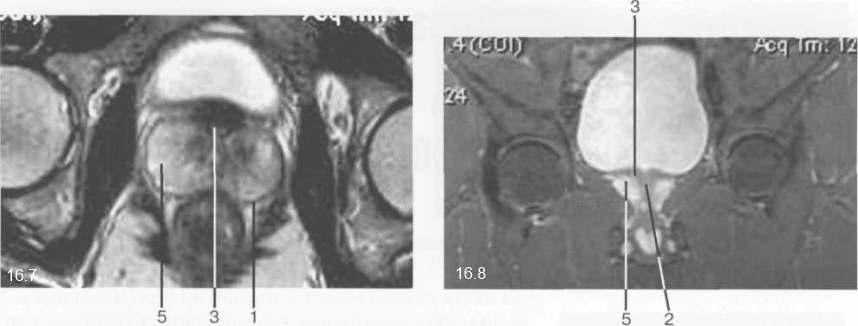 МРТ неизмененной предстательной железы. 