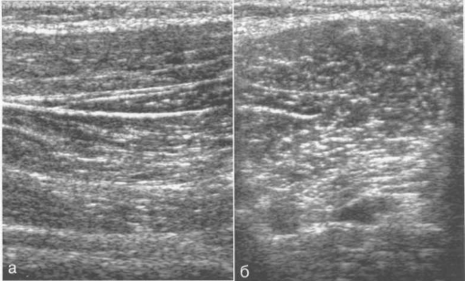 УЗИ скелетной мышцы в норме.