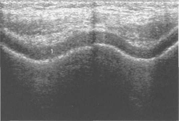УЗИ коленных суставов. Попереч­ное сканирование бедренных костей.