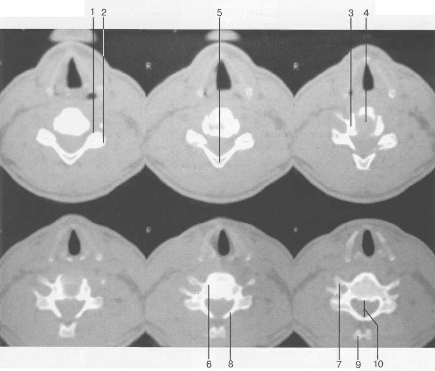 Аксиальные компьютерные томограммы шейных позвонков: