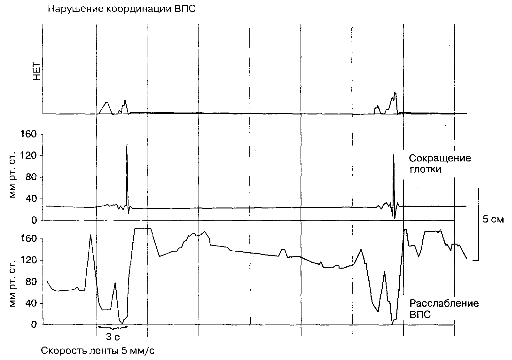 Дискоординация расслабления ВПС у больного с инсультом.