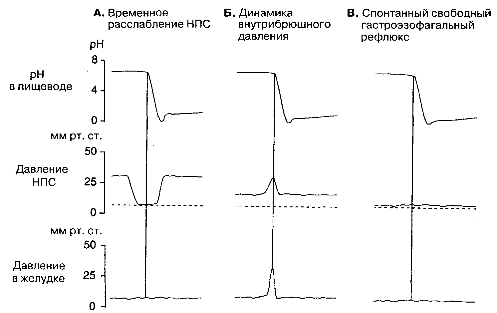 Схематическое представление о трех различных механизмах возникновения гастроэзофа­гального (ГЭ) рефлюкса.