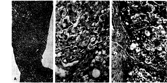 Дефицит а1-антитрипсина. (А) — биопсия печени больного в период первого года цирроза печени при малом увеличении светового микроскопа.