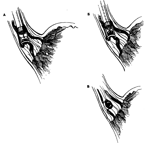 Эндоскоп с приспособлением для присасывания варикозного узла и его местной пере­вязки. (Б) Наложение резиновой петли на основание варикозного узла. (В) Эндоскоп удалили.