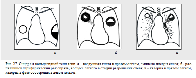 синдром кольцевидной тени в легких