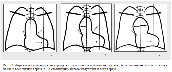 аортальная конфигурация сердца