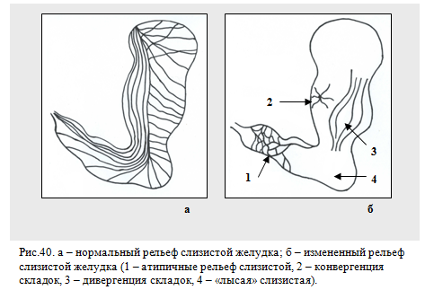 рельеф слизистой оболочки желудка