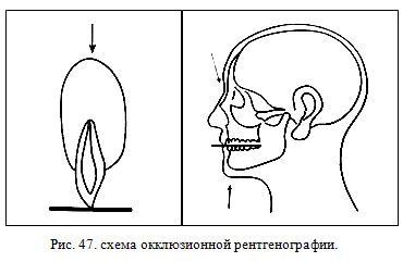 Окклюзионная рентгенография зубов