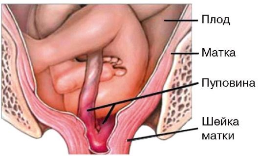 Выпадение петли пуповины