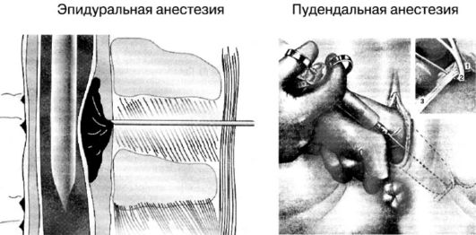 Пудендальная анестезия в родах