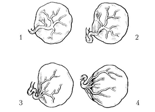 Варианты прикрепления пуповины: 1 - центральное; 2 - боковое; 3 - краевое; 4 - оболочечное.