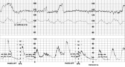 КТГ при дискоординации родовой деятельности