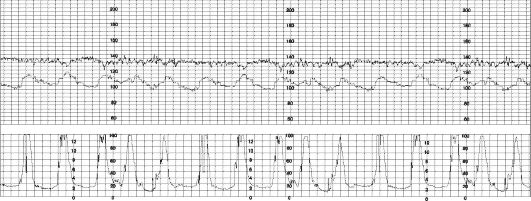 КТГ при бурной родовой