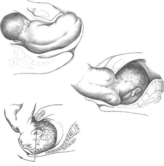 Биомеханизм родов при тазовом предлежании