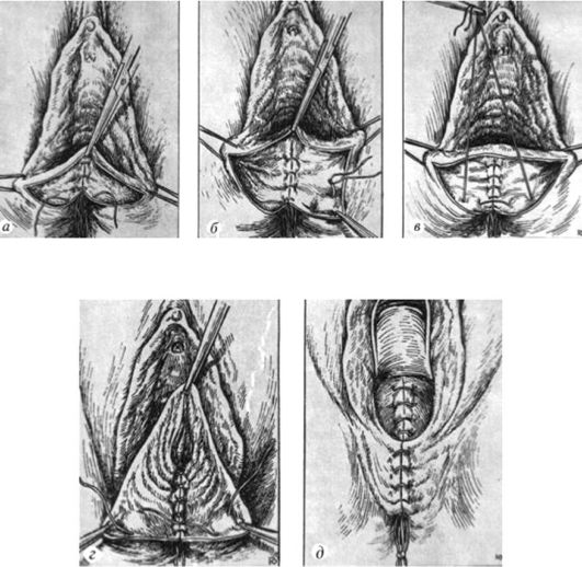 Зашивание разрыва промежности III степени: а - наложение швов на стенку прямой кишки; б, в - наложение швов на сфинктер прямой кишки; г - наложение швов на мышцы промежности; д конечный этап (восстановлена кожа промежности).