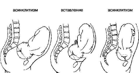 Асинклитизм и вставление