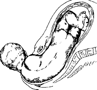 Четвертый момент - внутренний поворот плечиков и наружный поворот головки плода