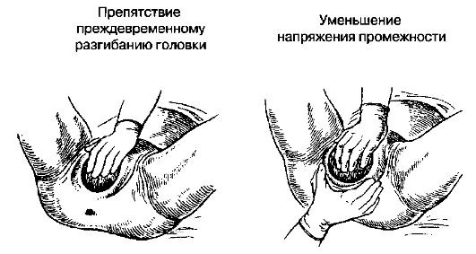 Препятствие преждевременному разгибанию головки. Уменьшение напряжения промежности