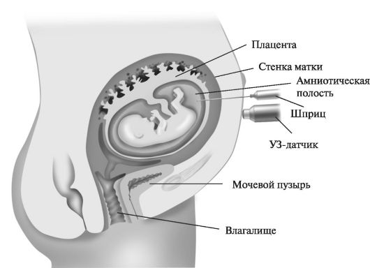 Амниоцентез