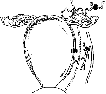Перевязка сосудов при органосохраняющих операциях: 1 - перевязка маточных артерий; 2 - перевязка внутренних подвздошных артерий; 3 - перевязка яичниковых артерий.