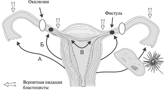 Потенциальные варианты трансмиграции яйцеклетки и/или сперматозоидов: А - наружная трансабдоминальная миграция яйцеклетки; Б - трансабдоминальная миграция сперматозоидов; В - внутренняя миграция зиготы в маточную трубу из полости матки